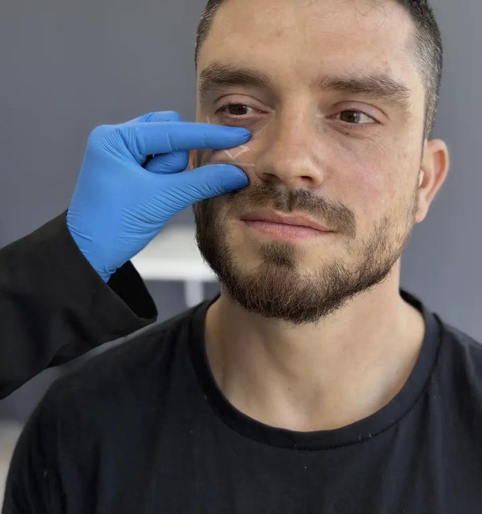 rha restylane