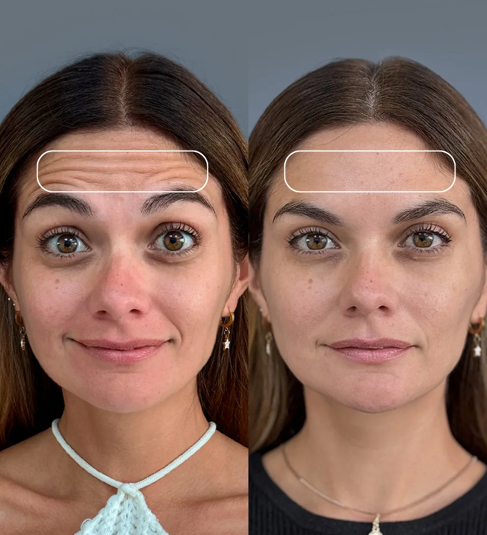 Doctora Blanca Girardi de Steve 3 Botox 3 zonas líneas expresión