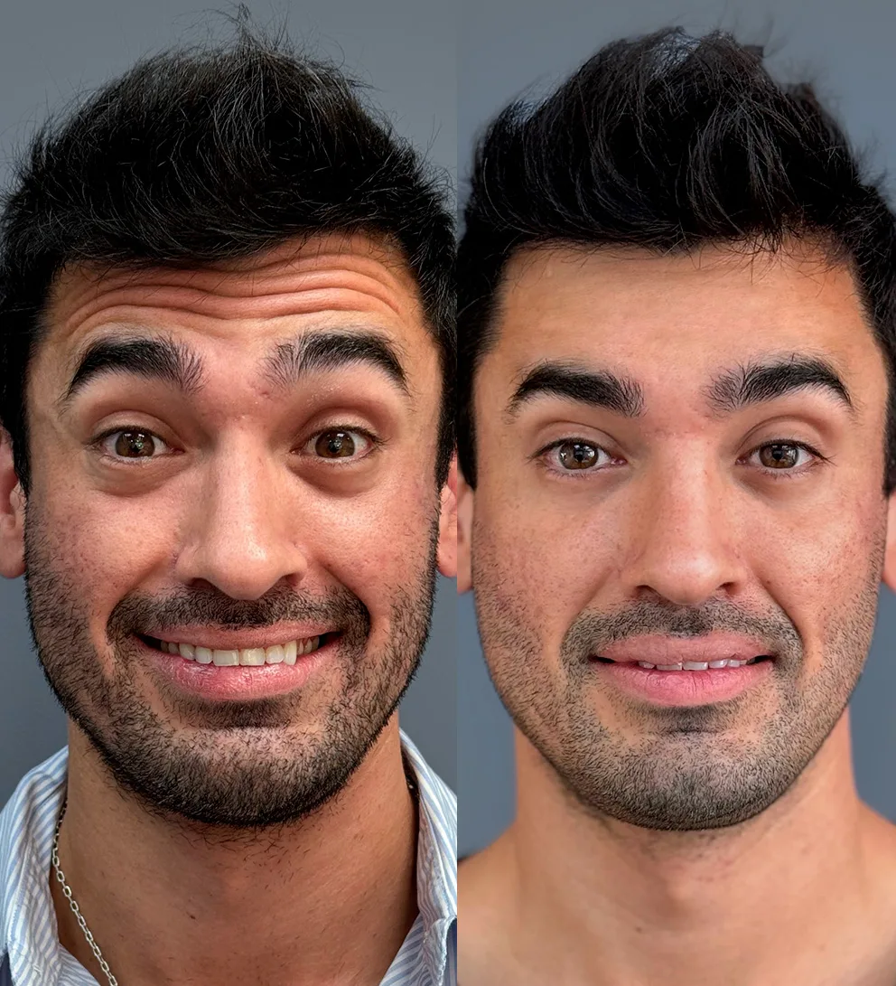 Botox 3 zonas líneas expresión 4 Botox 3 zonas líneas expresión