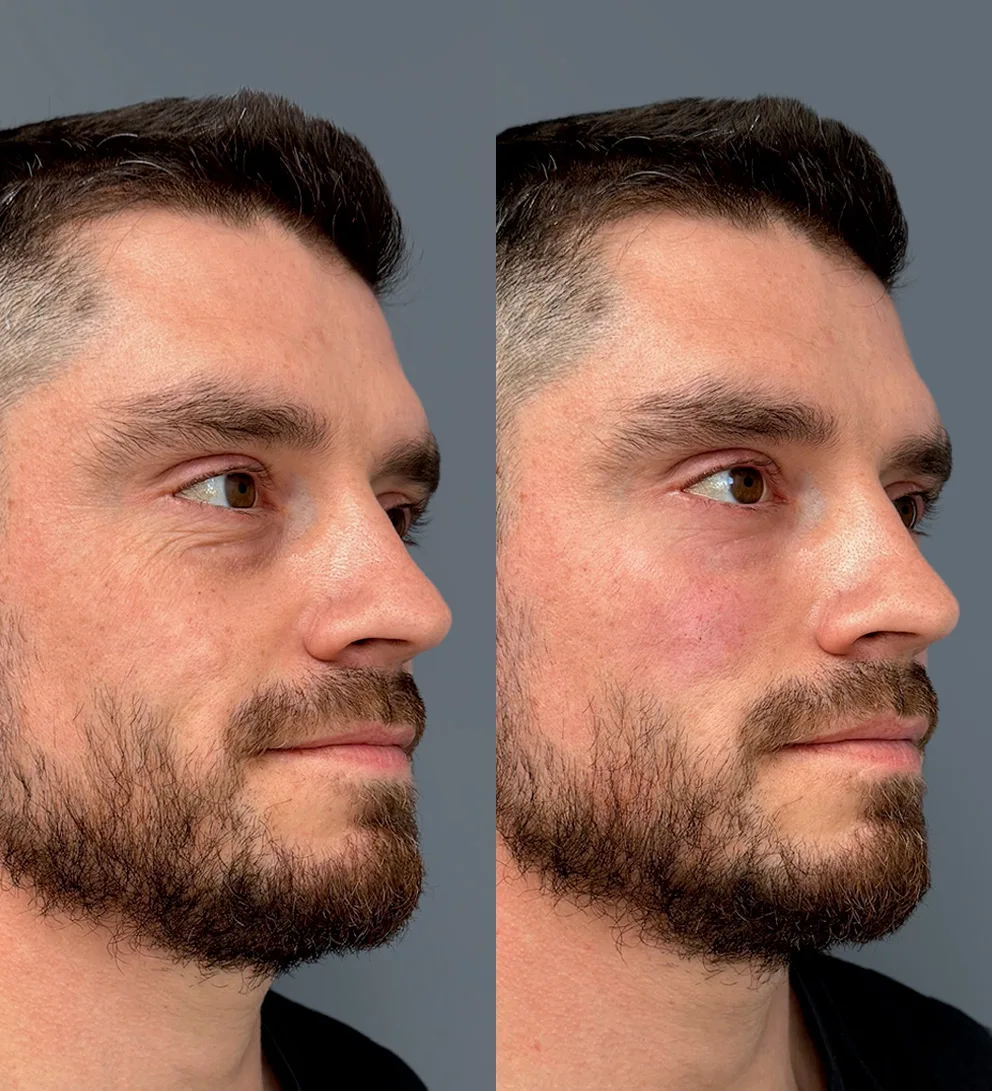 Relleno malar con &aacute;cido hialur&oacute;nico