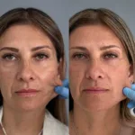 Portada AD Hydroxyfill visitadora