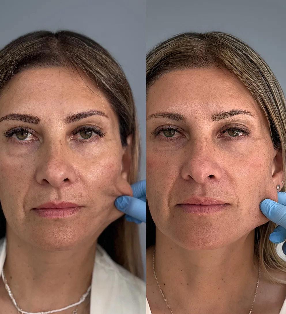 Hydroxyfill bioestimulador col&aacute;geno