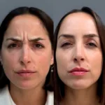 Portada AD botox 3zs