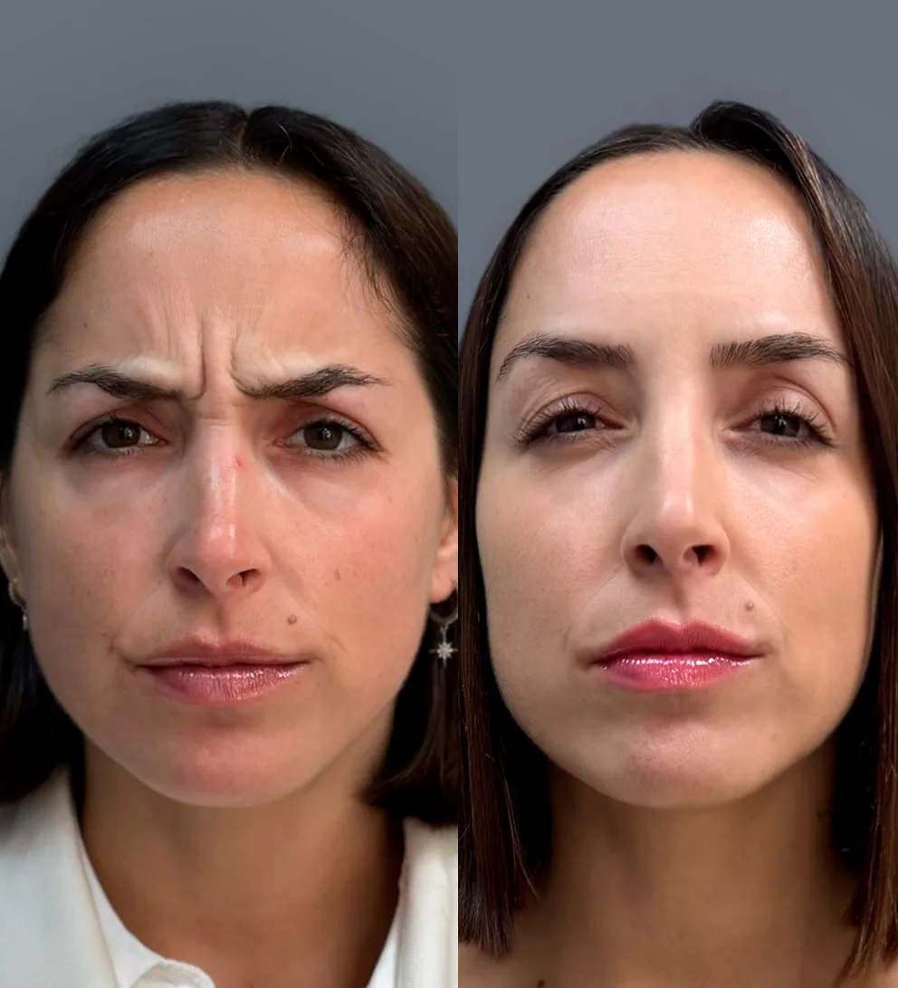 Botox 3 zonas líneas expresión