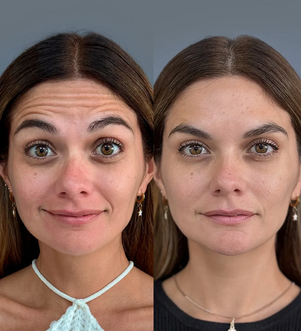 Botox 3 zonas líneas expresión 2 Botox 3 zonas líneas expresión