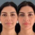 Portada AD relleno labios teoxane 1