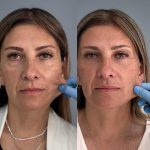 Hydroxyfill bioestimulador colágeno 2 hydroxyfill antes y despues