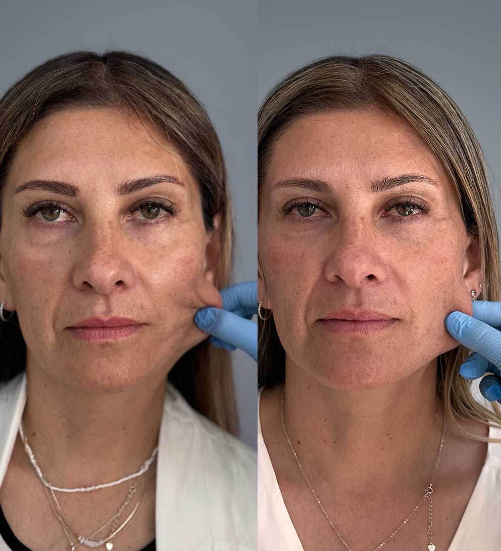hydroxyfill antes y despues