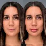 Relleno de labios con ácido hialurónico 2 resultado relleno labios