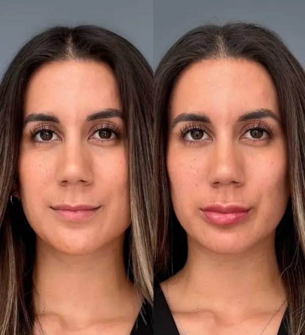 resultado relleno labios