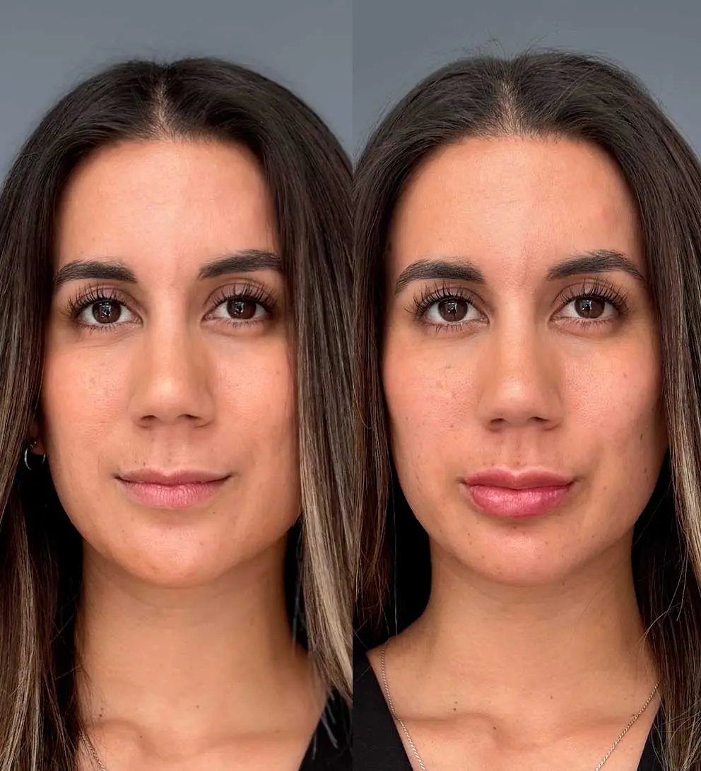 resultado relleno labios