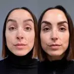 Botox 3 zonas líneas expresión 2 resultados botox toxina botulinica