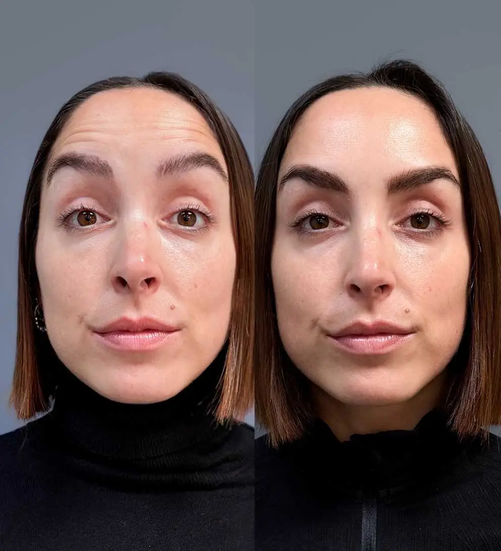 resultados botox toxina botulinica