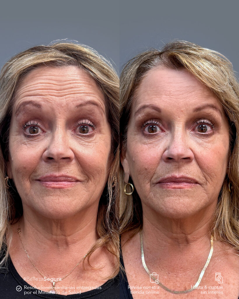 Botox: 7 razones poderosas para elegirlo en tu rejuvenecimiento facial 1 Resultados naturales de rejuvenecimiento con Botox en Clínica EM