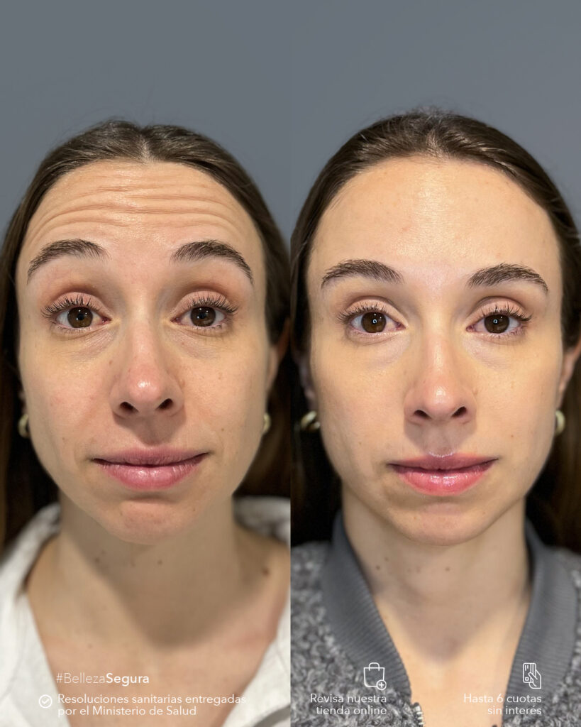 Botox antes y después: lo que nadie te cuenta y necesitas saber 1 Botox antes y después en frente. Clínica EM