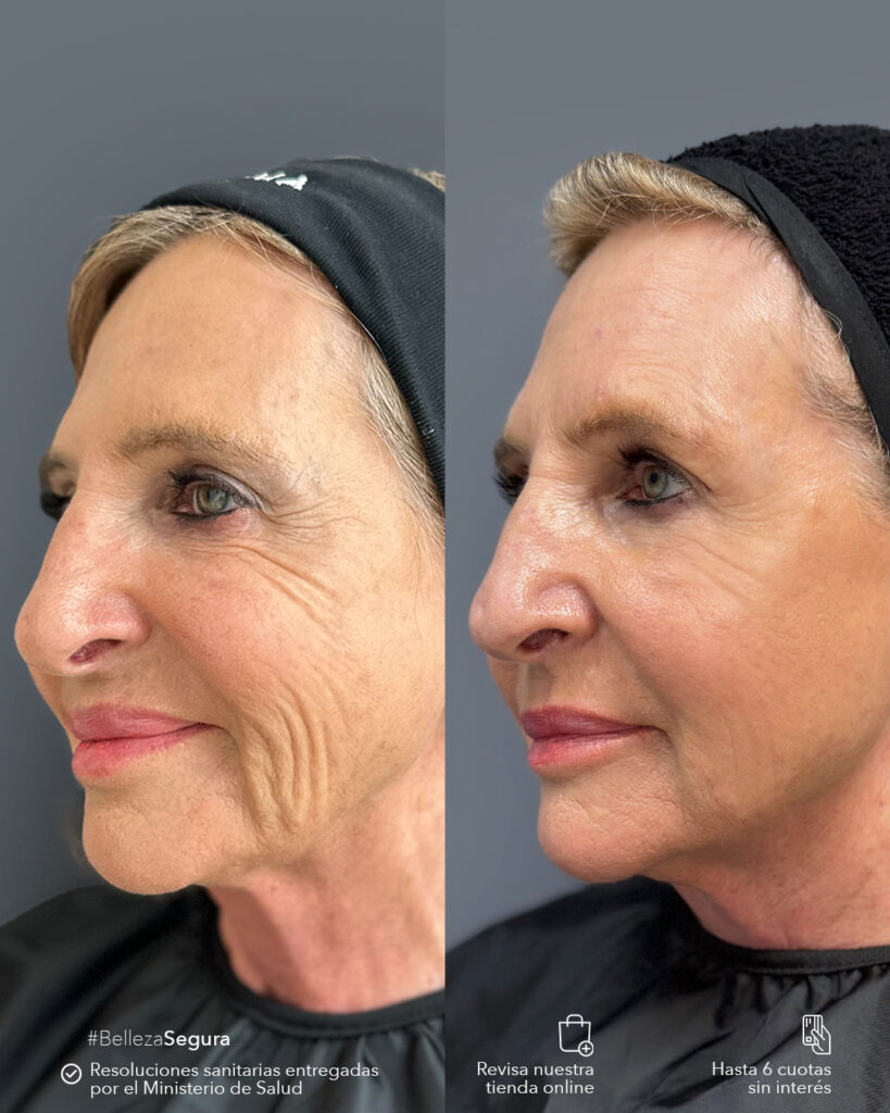Sculptra: Bioestimulación de Colágeno que Transforma tu Piel en 3 Etapas 1 Resultados de Sculptra en bioestimulación de colágeno en Clínica EM