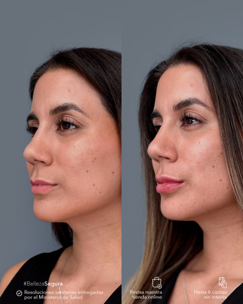 Relleno de labios: el secreto para un resultado natural y seguro 1 Relleno de labios natural con ácido hialurónico en Clínica EM
