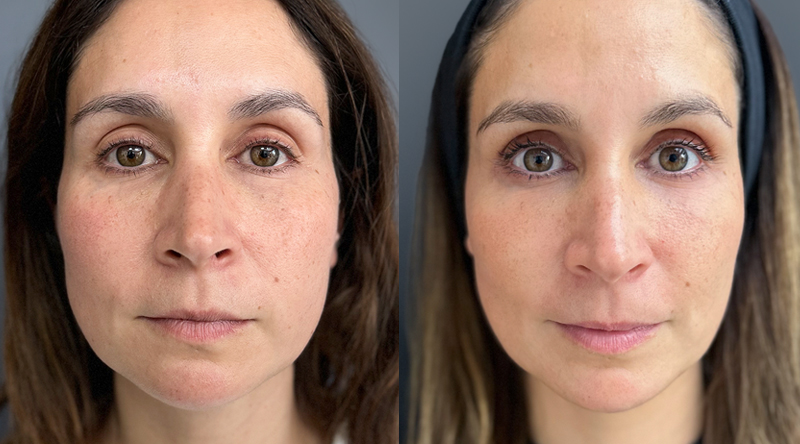 Radiesse: Innovación en rejuvenecimiento facial 2 Radiesse Antes y después