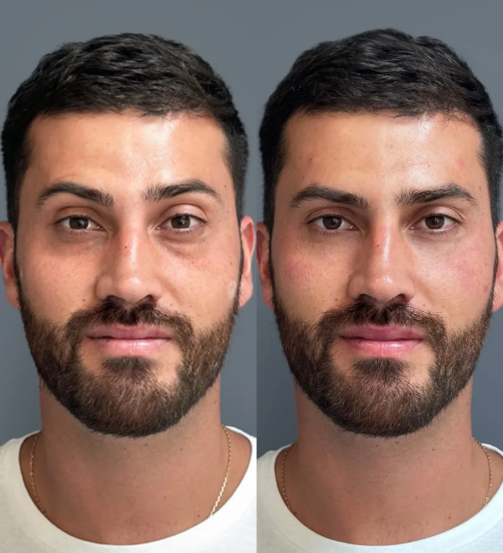 Relleno de ojeras con ácido hialurónico Teoxane 3 Relleno de ojeras con ácido hialurónico Teoxane