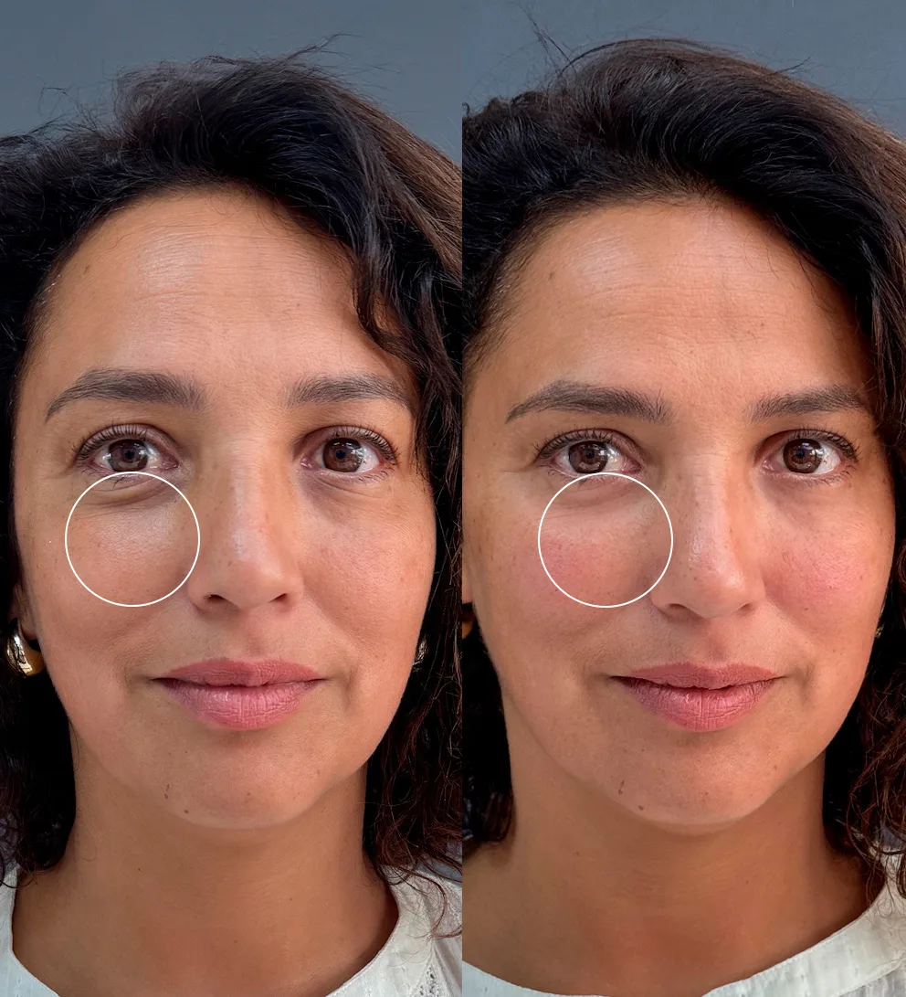 Doctora Blanca Girardi de Steve 2 Relleno de ojeras con ácido hialurónico Teoxane