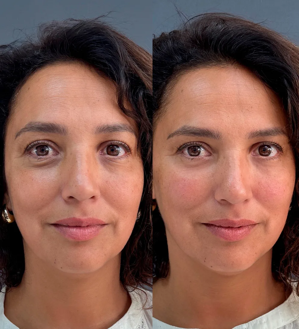 Relleno de ojeras con ácido hialurónico Teoxane 2 Relleno de ojeras con ácido hialurónico Teoxane