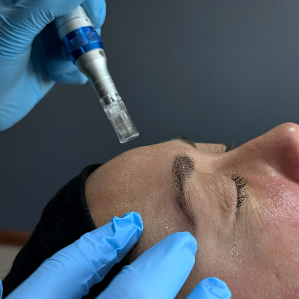 Plasma rico en plaquetas: 5 razones por las que este tratamiento biológico es seguro y efectivo 1 Plasma rico en plaquetas para regeneración de la piel en Clínica EM.