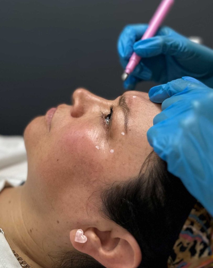 Botox cuándo empieza hacer efecto. Guía clara con tiempos reales 3 Botox cuándo empieza hacer efecto. Guía clara con tiempos reales