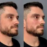 Relleno malar con ácido hialurónico 2 relleno de ojeras