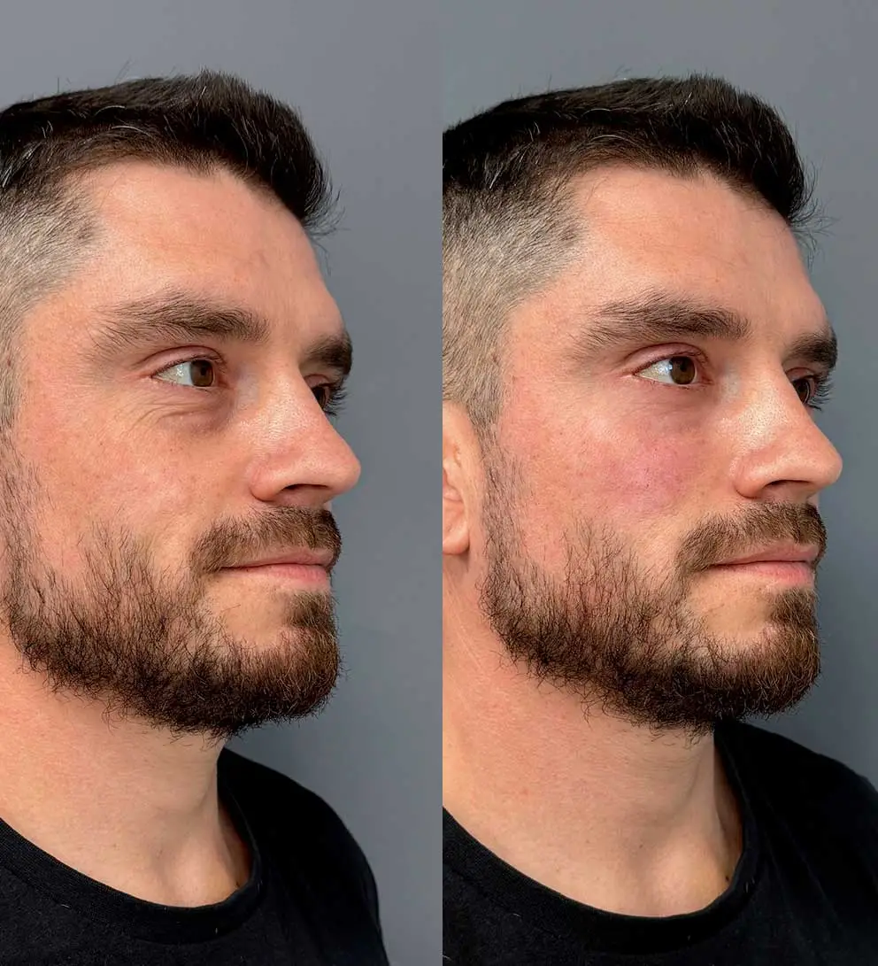 relleno de ojeras