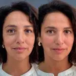 Relleno de ojeras con ácido hialurónico 2 relleno ojeras resultado