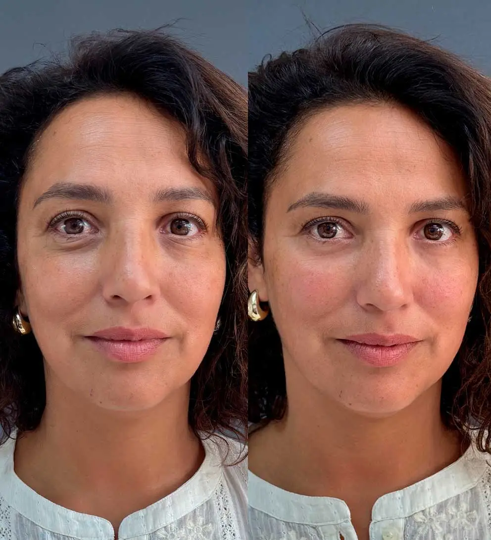 relleno ojeras resultado