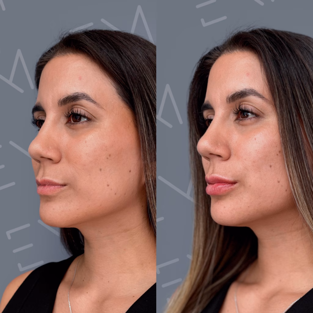 Relleno de labios: Antes y después que realmente sorprenden 1 Resultados naturales de relleno de labios en Clínica EM.