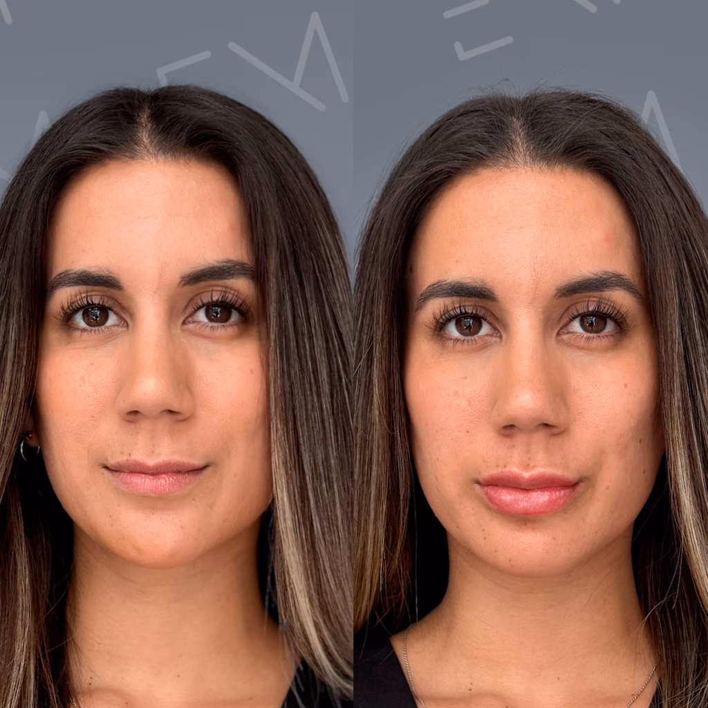 ácido hialurónico aplicado en labios con resultados naturales