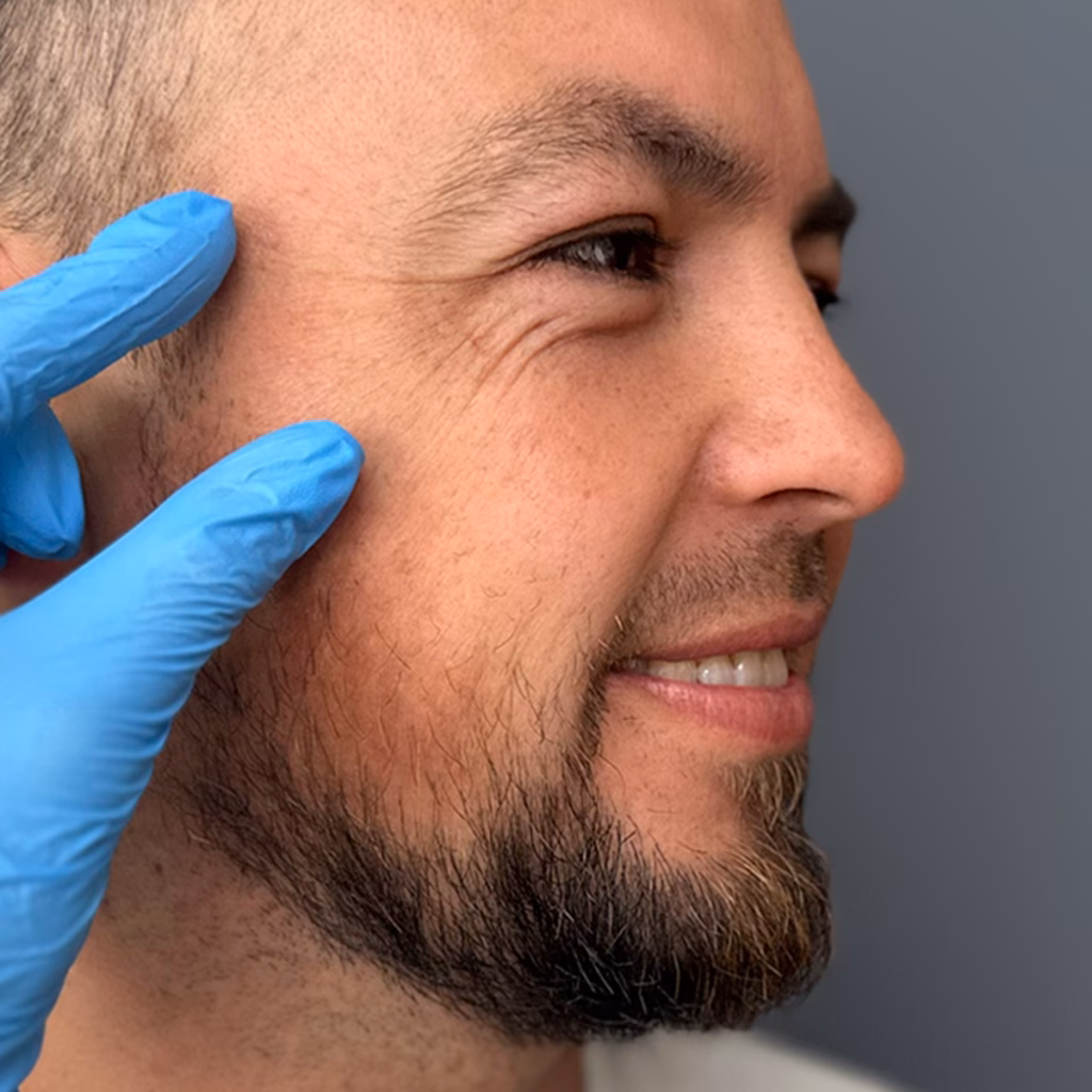 contorno de ojos rejuvenecido con medicina estética