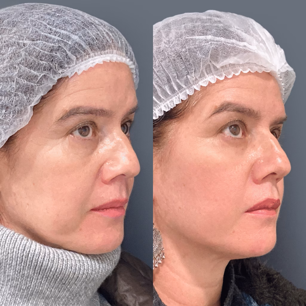 Radiesse: el bioestimulador que rejuvenece la piel de forma natural 1 Radiesse para rejuvenecimiento del rostro en Clínica EM