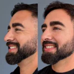 Portada AD Botox relleno valle