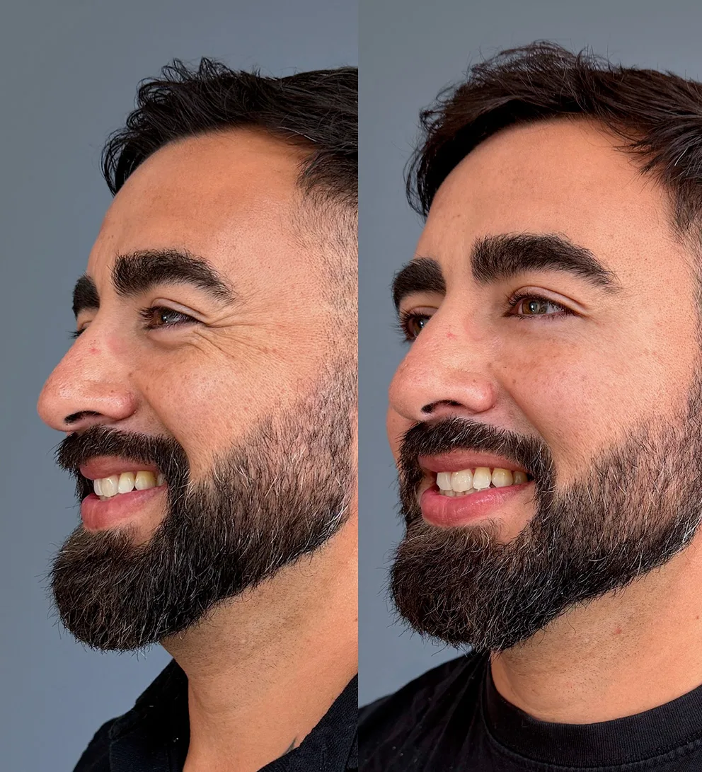 Botox® 3 zonas + Teoxane® relleno ácido hialurónico