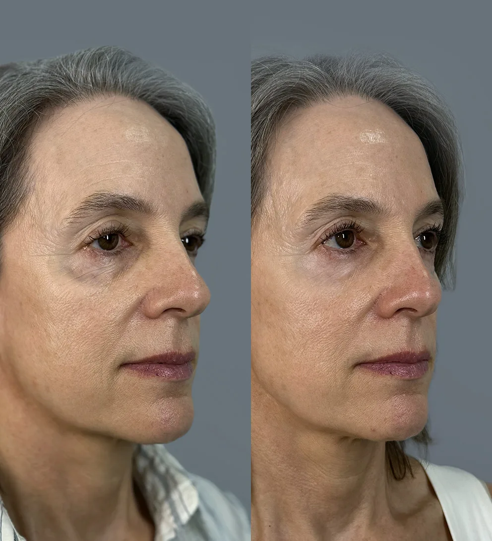 NucleoFill™ Eyes polinucleótidos de salmón contorno de ojos