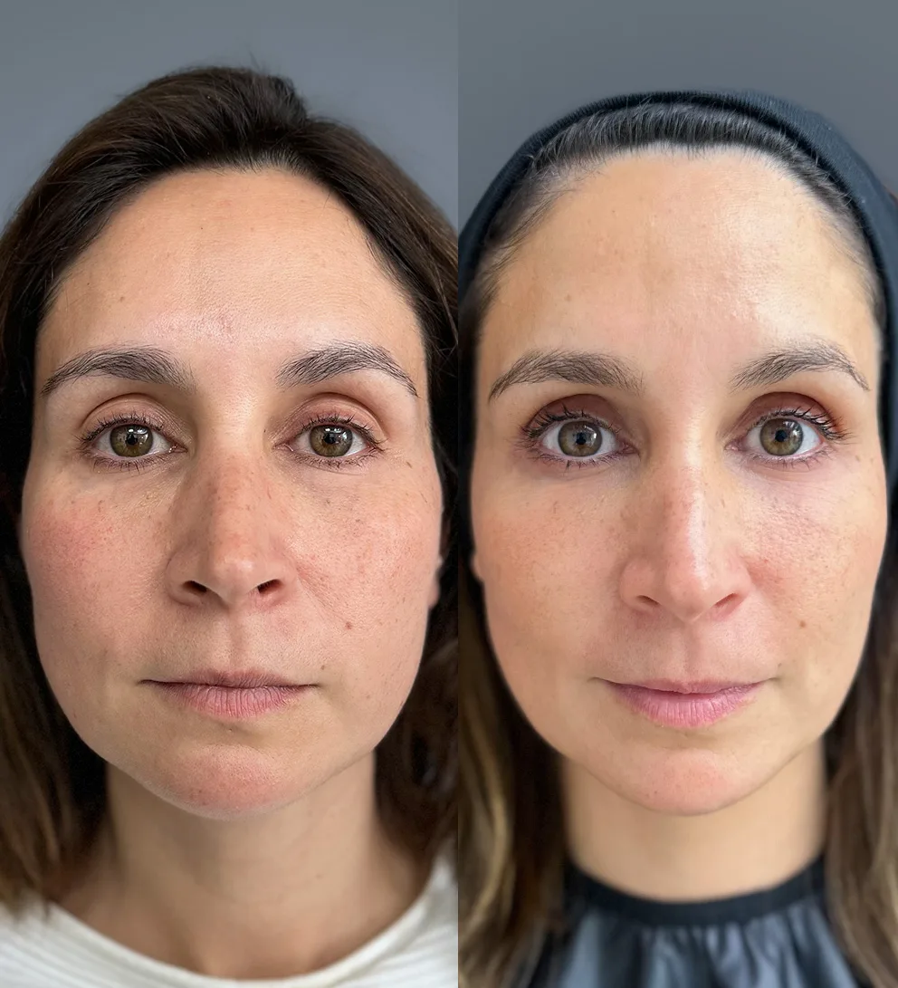 Radiesse® Bioestimulación de colágeno