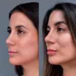 Portada AD Relleno PRP 1