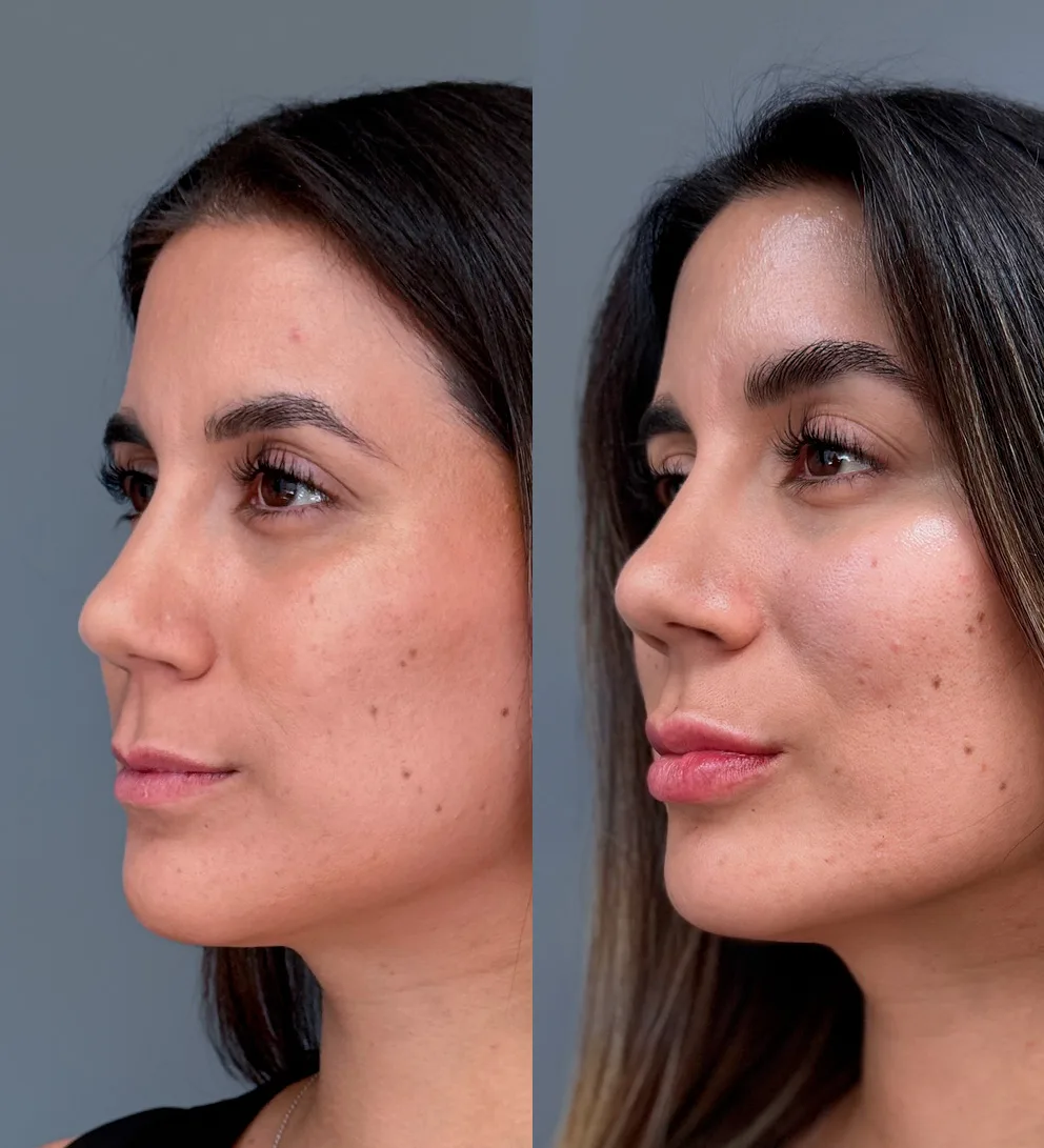 Plasma rico en plaquetas + relleno con ácido hialurónico Teoxane®