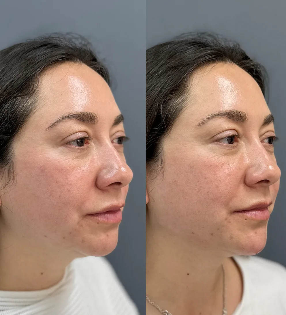 Contorno mandibular con ácido hialurónico Teoxane®