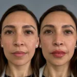 Portada AD Relleno labiosBotox