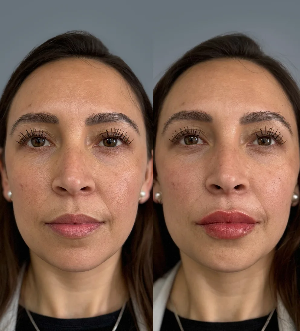 Botox® 3 zonas + relleno de labios con ácido hialurónico Teoxane®