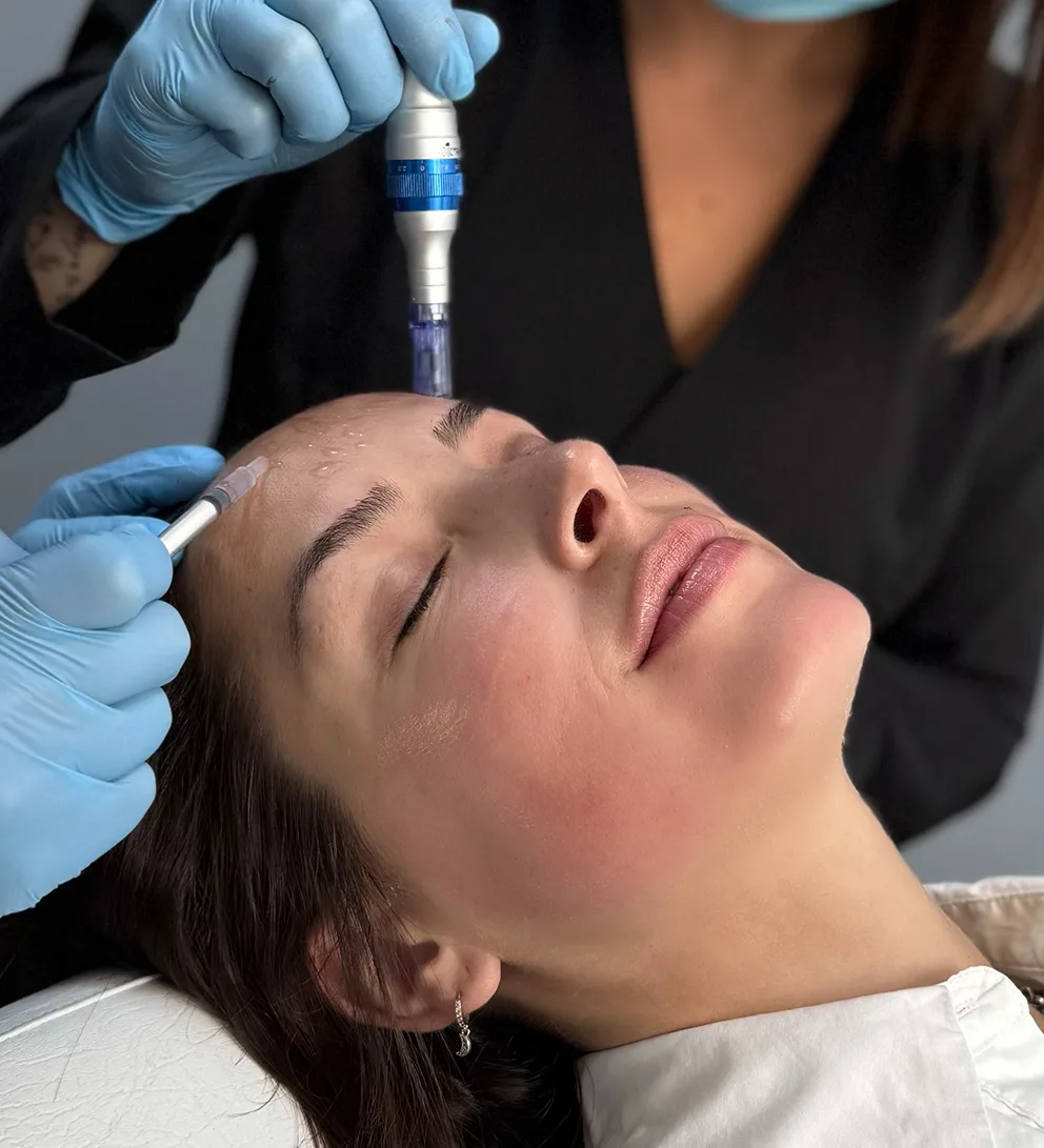 Relleno de labios con ácido hialurónico Teoxane® + Pink Glow®