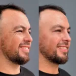 Rinomodelaci&oacute;n