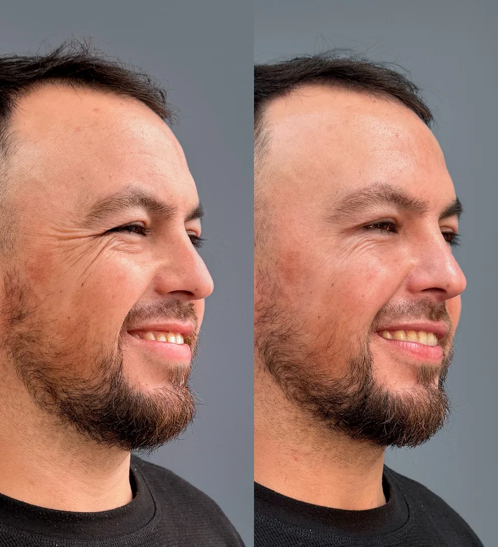 Rinomodelaci&oacute;n