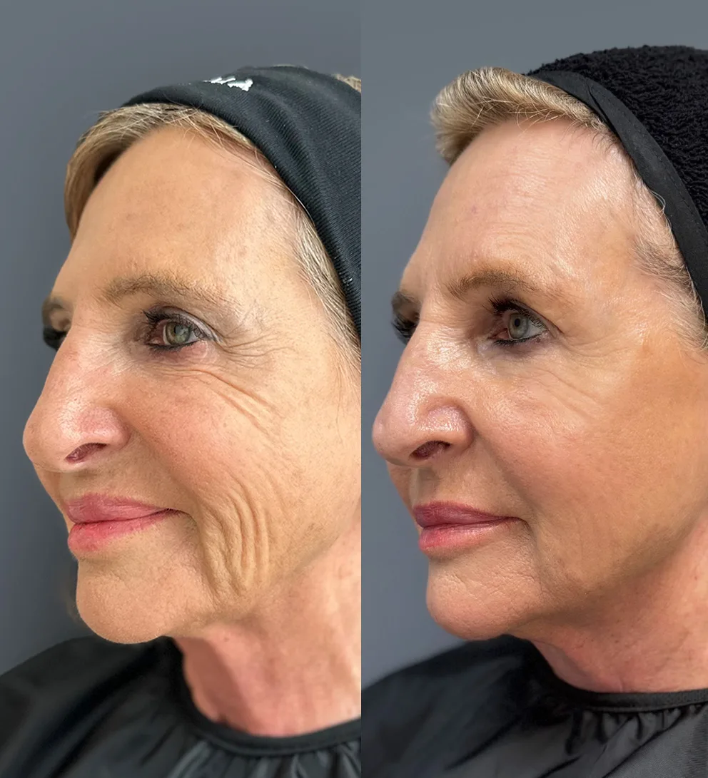 Sculptra&reg; bioestimulaci&oacute;n facial 1 sesi&oacute;n