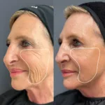Sculptra® bioestimulación facial 1 sesión 3 sculptra
