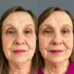 Portada AD Skinboost perilabial